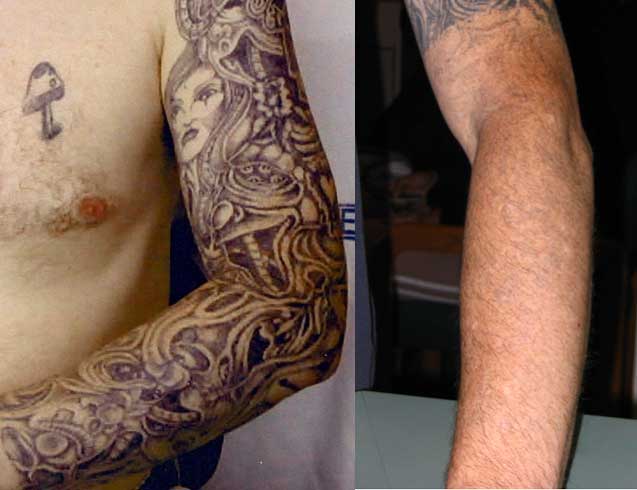 10 THINGS YOU SHOULD KNOW ABOUT LASER TATTOO REMOVAL  Lead The Followers 