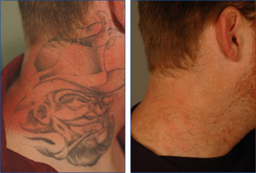 Feeling Smooth  Laser Tattoo Removal