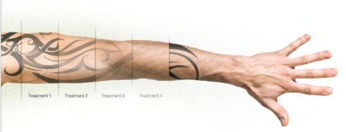 tattoo-removal3 | Tattoo Removal