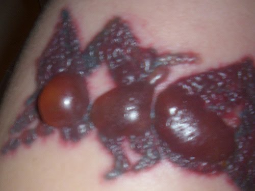 tattoo-removal1 | Tattoo Removal | Page 3